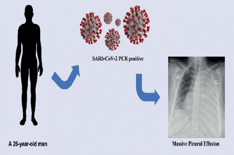 Massive Pleural Effusion With Adenosine Deaminase ADA Test Positive massive-pleural-effusion-with-adenosine-deaminase-ada-test-positive