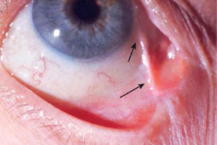 Symblepharon connecting the lid margin and perilimbal conjunctiva is observed in ocular cicatricial pemphigoid.