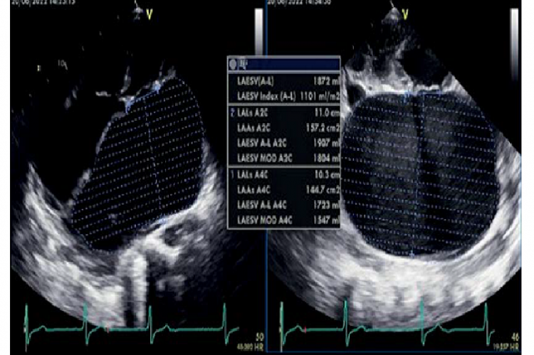 Transthoracic echocardiographic (TTE) examination showed an extremely huge left atrium of 13.9 mm x 12.3 mm on the apical four-chamber view with LAVi of 1101 ml/m2.