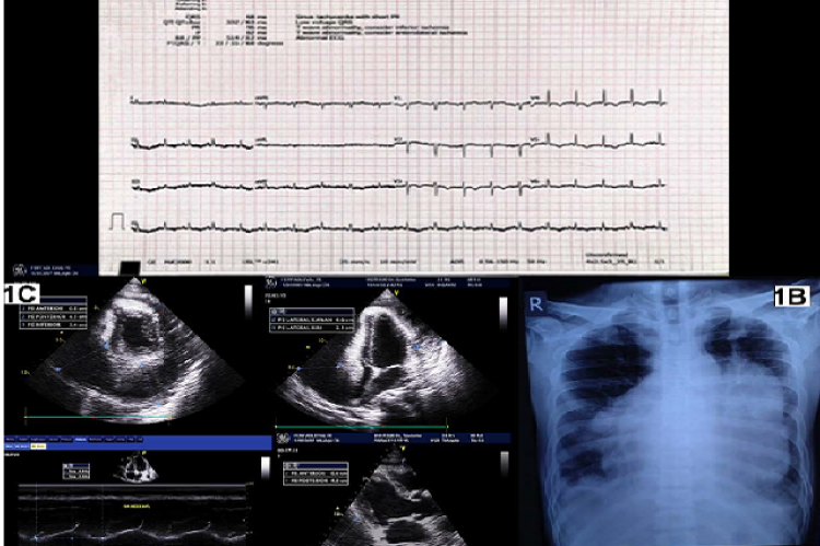 ECG reveals electrical alternans and low voltage, (B) CRX reveals the Erlenmeyer sign