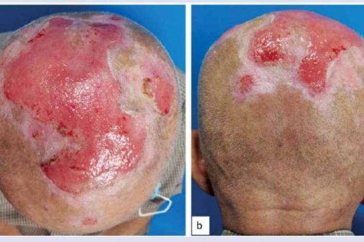 An ulcer with well–defined borders, and flat edges, with a granulation tissue base at (A) central vertex and (B) posterior vertex