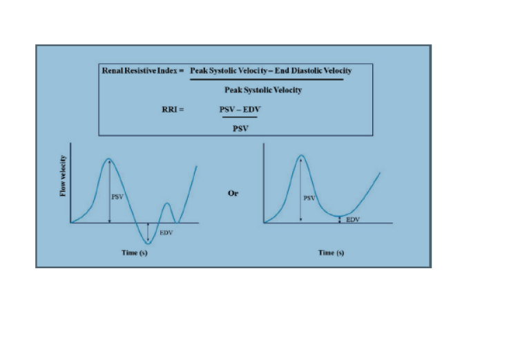 Calculation the renal resistive value index (RRI), where PSV is the peak systolic velocity and EDV is the end diastolic velocity.