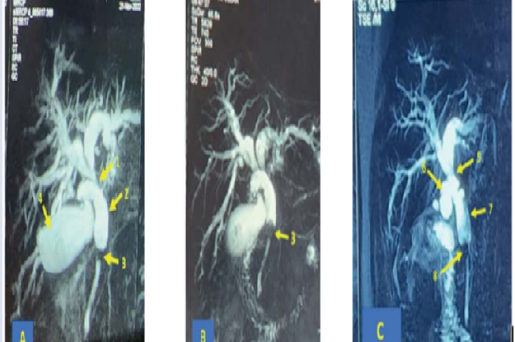 Cystic-duct stone does not directly compress the CBD.