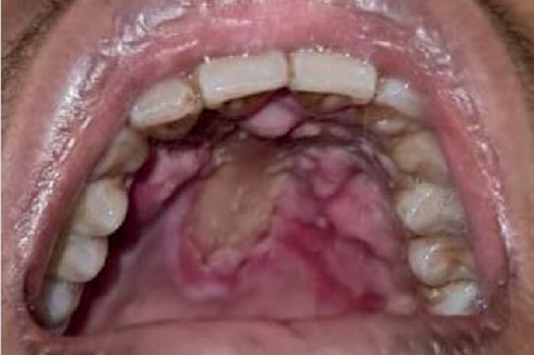 Clinical resolution after 11 days of fluconazole injection