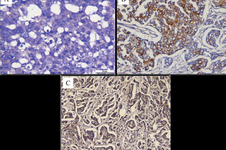 VDR expression in invasive breast carcinoma of NST tumor cells. (A) Weak positive expression, 400x magnification (B) Moderate positive expression, 200x magnification (C) Strong positive expression, 200x magnification