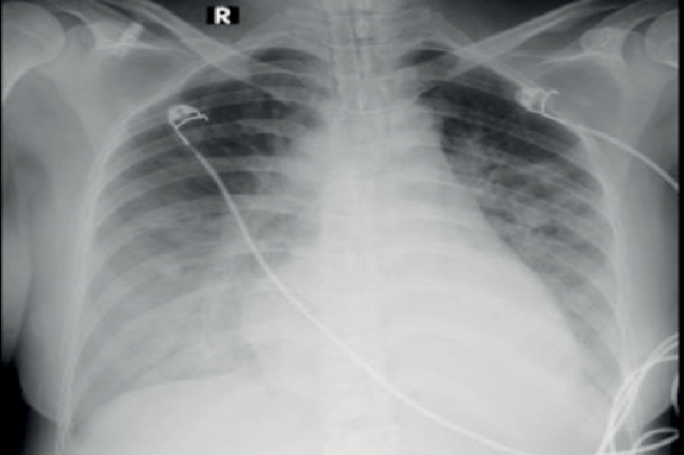 Chest x-ray.