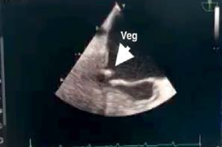 The image shows cardiac mitral valve vegetation observed during TEE