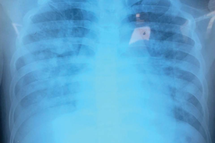 Chest x-ray showed edema in both lungs on the 3rd day postsurgery