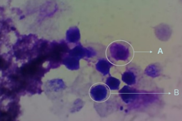 Peritoneal fluid smear with 1000x magnification (A) Active  macrophages and (B) Inactive macrophages.