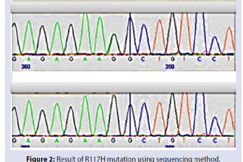 Result of R117H mutation using sequencing method.