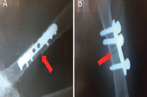 Radiograph of the left femur in (A) commercial plate group, (B) 304 stainless-steel plate group at 24 h postoperatively.