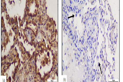 IL-6 expression in the COVID-19 and non-COVID-19 groups, magnification 400x.