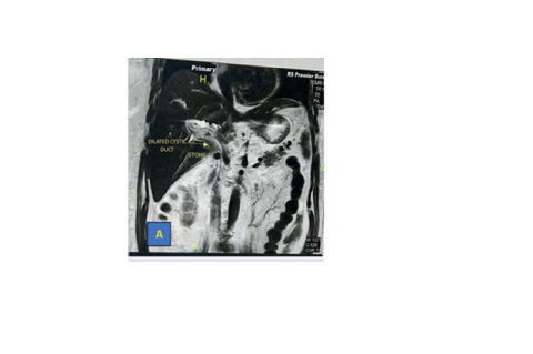 Cystic-duct stone does not directly compress the CBD.