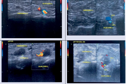 Lower Extremity Venous Ultrasound Doppler, Showed Thrombuses on The Left Femoral and Popliteal Vein.