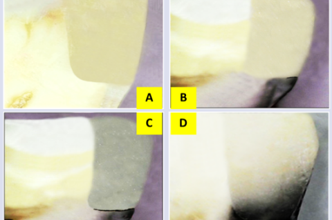 : Digital photographs represented the microleakage scores; score  0: (A), score1: (B), score 2: (C), score 3: (D).